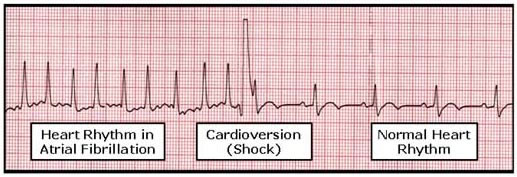 cardioversion-montgomery-cardiovascular-associates